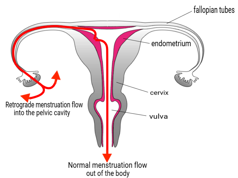 Heavy periods and retrograde bleeding (Period blog 3) Noigroup